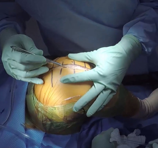 Hip-Knee-Replacement