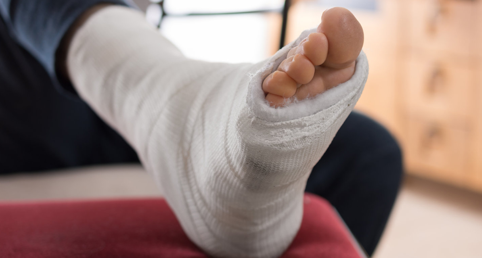 Plaster-Care-Fracture-Reduction