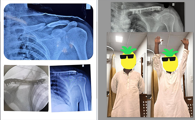 clavicle-fracture-plate-fixation
