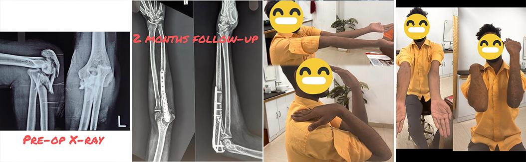 complex-elbow-fracture-recovery