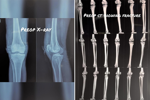 lateral-condyle-Hoffas-fracture-thumbnail