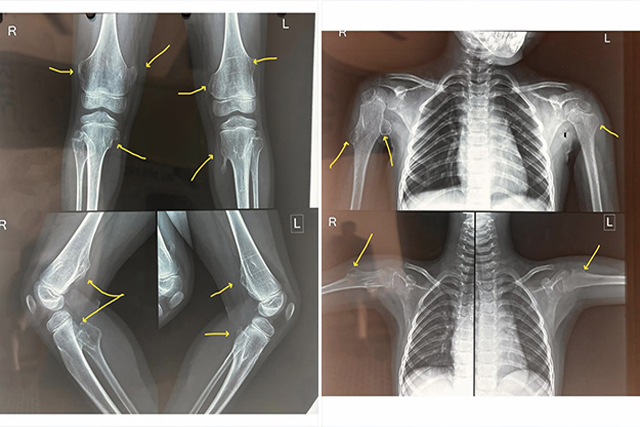 multipleh-hereditary-exostosis-MHE-thumbnail