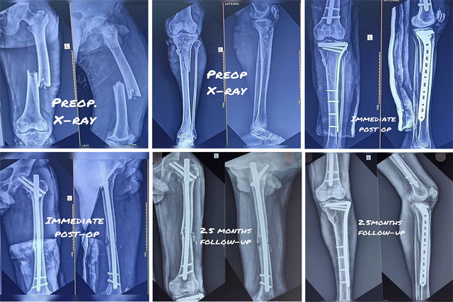 polytrauma-fixation-thumbnail
