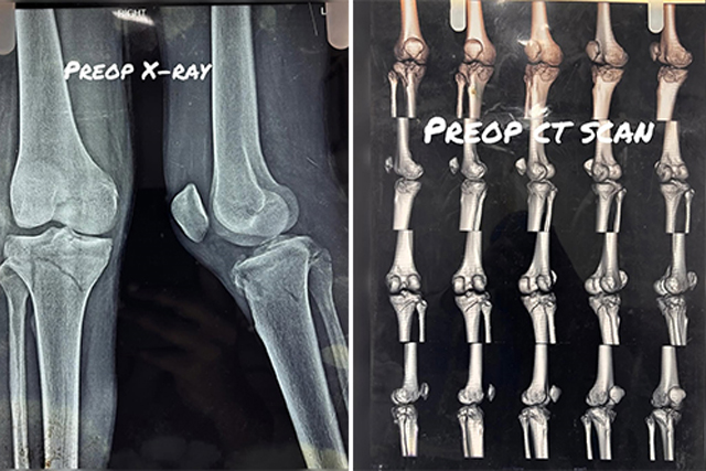 severe-proximal-tibia-fracture-thumbnail