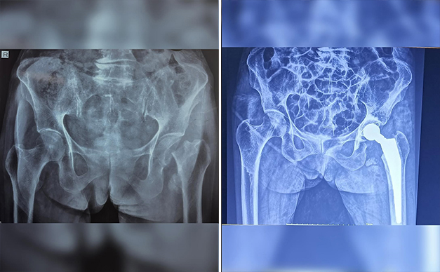 total-hip-replacement