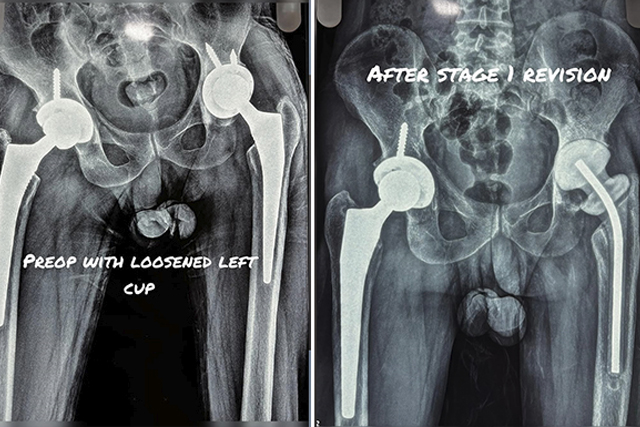 two-stage-revision-hip-replacement-thumbnail